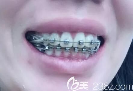 牙齒擁擠錯亂在昆明德韓口腔做金屬自鎖托槽牙齒矯正，戴牙套9個月開始收牙縫啦