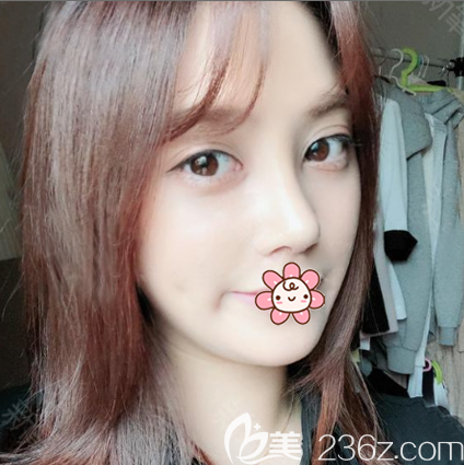 看我找廣州荔醫(yī)李增產(chǎn)做的雙眼皮隆鼻怎么樣 看我找廣州荔醫(yī)李增產(chǎn)做的雙眼皮隆鼻怎么樣