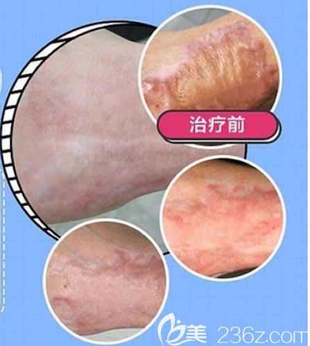 呼市京美于曉昆去除燙傷疤痕效果怎么樣