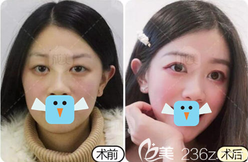 成都成美王立鵬雙眼皮術(shù)前術(shù)后對比圖
