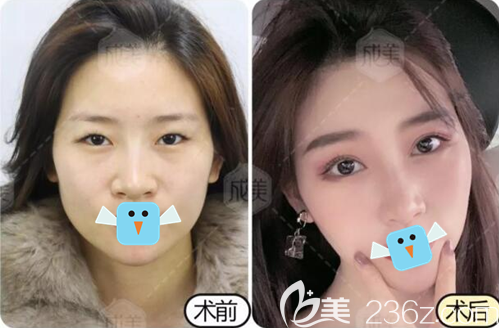 成都成美羅榮懷阿爾法美眼術(shù)后效果圖