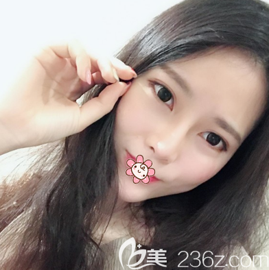 ?玻尿酸隆鼻效果不持久,于是我去廣州荔醫(yī)找鄒順祿做了鼻綜合隆鼻一個月后秒變女神