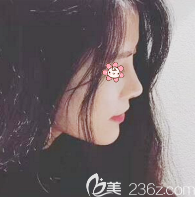 廣州荔醫(yī)鄒順祿隆鼻案例一個(gè)月側(cè)面效果圖 廣州荔醫(yī)鄒順祿隆鼻案例一個(gè)月側(cè)面效果圖