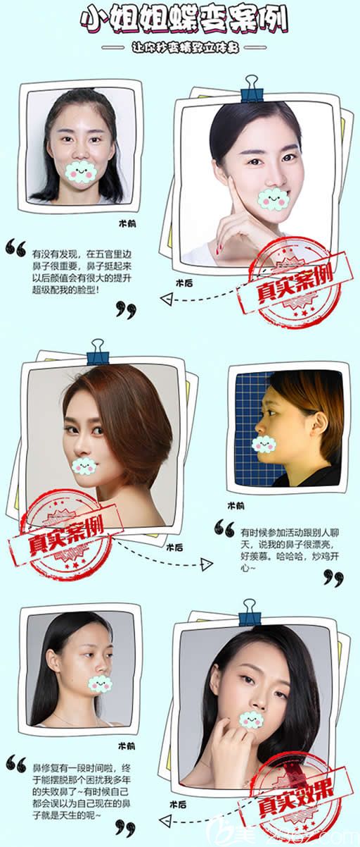 臺州藝星整形隆鼻案例效果