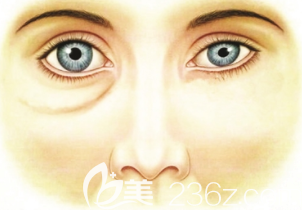 眼袋示意圖
