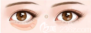 祛眼袋前后效果對比圖