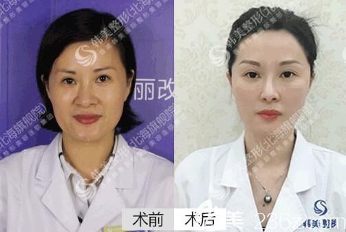 這是我在北海韓美整形做全臉線雕提升前后對比照片，親們覺得我面部埋線的效果怎么樣