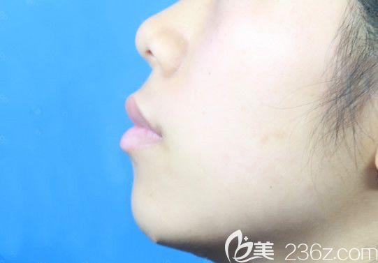 呼和浩特京美整形醫(yī)院找馬曉艷醫(yī)生做硅膠假體墊下巴前的照片 呼和浩特京美整形醫(yī)院找馬曉艷醫(yī)生做硅膠假體墊下巴前的照片