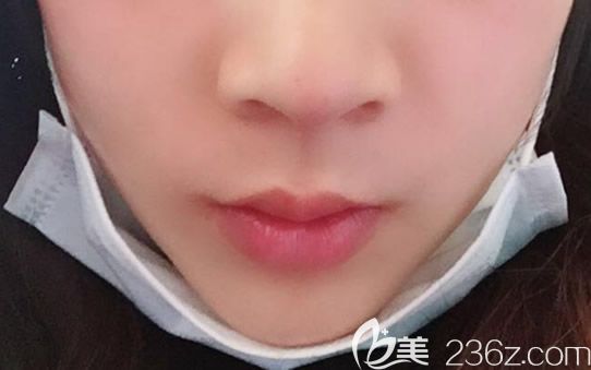 假體墊下巴第六天圖片 假體墊下巴第六天圖片