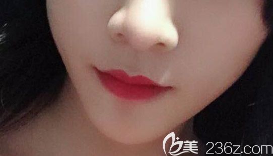 呼和浩特京美做完假體墊下巴一個(gè)月 呼和浩特京美做完假體墊下巴一個(gè)月