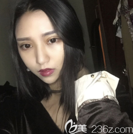 鼓起勇氣在韓國清潭fist成鎮(zhèn)模做切開雙眼皮開眼角結(jié)果還不錯