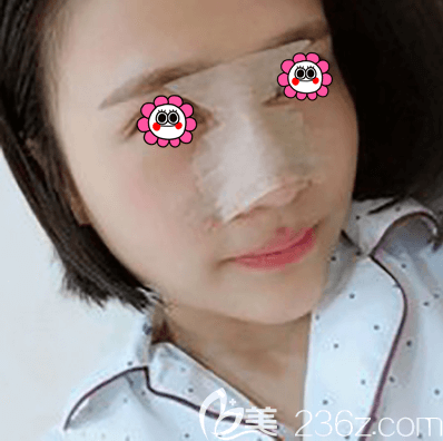 劉文峰醫(yī)生給我做鼻綜合第3天樣子 劉文峰醫(yī)生給我做鼻綜合第3天樣子