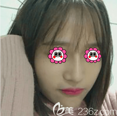 北京紫潔醫(yī)美劉文峰鼻綜合案例 北京紫潔醫(yī)美劉文峰鼻綜合案例