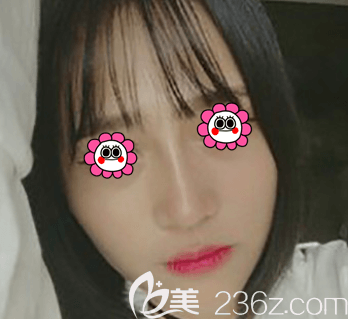 對于鼻綜合包括哪些項目我做了了解后就找北京紫潔劉文峰做了手術(shù)