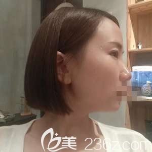 激光祛斑術(shù)后兩周，疤痕和色素已經(jīng)完全消退