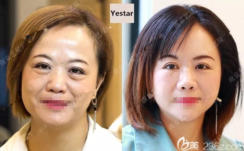 眼袋厚重、八字紋明顯的她在南京藝星做了脂肪重置填充，不夠的脂肪從大腿內(nèi)側(cè)吸脂術(shù)后視覺上年輕五歲有余