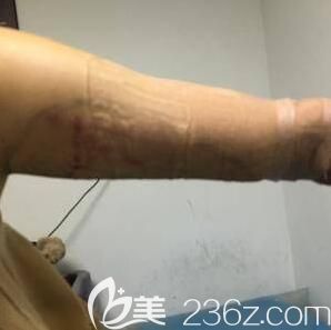 水動力手臂吸脂術(shù)后恢復(fù)照 水動力手臂吸脂術(shù)后恢復(fù)照