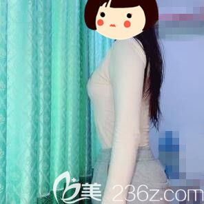 在長沙yestar做手臂吸脂術(shù)后20天效果 在長沙yestar做手臂吸脂術(shù)后20天效果