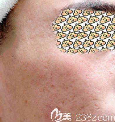 第1次點陣激光祛痘坑效果圖