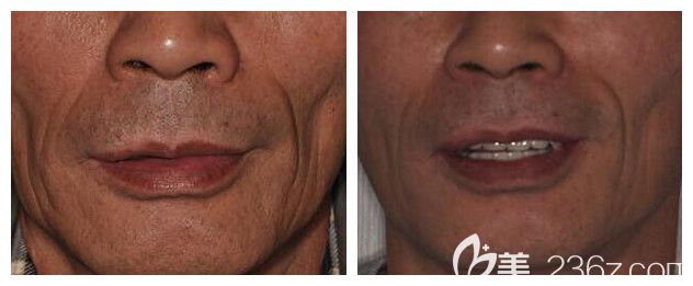 昆明德韓口腔全口種植牙案例