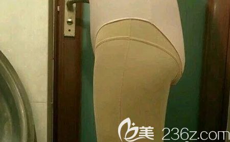 找贛州韓美美容醫(yī)院何斌做大腿吸脂術(shù)后第4天 找贛州韓美美容醫(yī)院何斌做大腿吸脂術(shù)后第4天