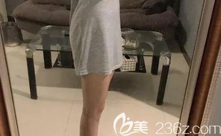 找贛州韓美美容醫(yī)院何斌做大腿吸脂術(shù)后第16天 找贛州韓美美容醫(yī)院何斌做大腿吸脂術(shù)后第16天