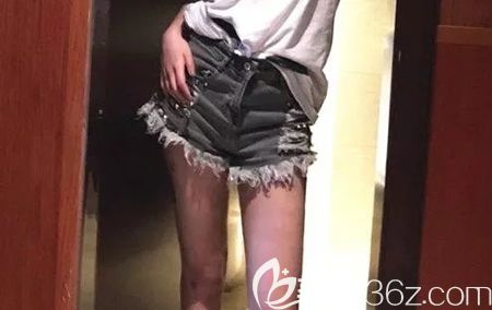 在贛州韓美找何斌做大腿吸脂3個(gè)月后我腿細(xì)了6cm，分享大腿吸脂后快速恢復(fù)技巧給大家