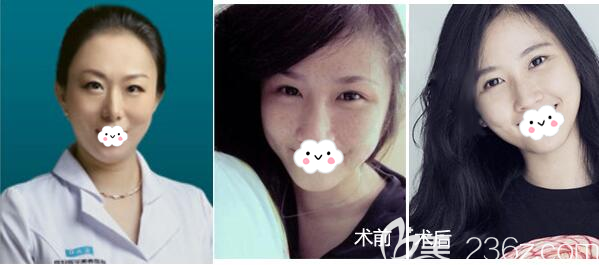 成都悅好楊翠霞皮秒祛斑案例