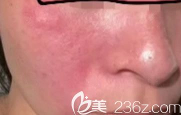 包頭華美整形醫(yī)院激光去紅血絲前