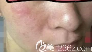 980激光去紅血絲第11天效果圖