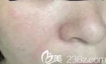 包頭華美激光去紅血絲第3次后的恢復(fù)效果