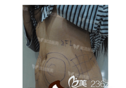 在北京紫潔做腰腹吸脂前樣子 在北京紫潔做腰腹吸脂前樣子