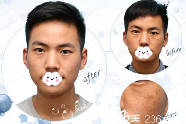 成都銅雀臺(tái)楊志宏皮秒激光祛斑案例效果