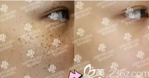 成都市西區(qū)醫(yī)院皮秒激光祛斑前后對(duì)比圖