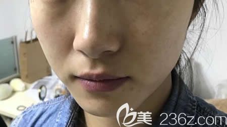 在<!--<i data=20240703-sp></i>-->整形醫(yī)院找周玲主任做激光祛斑術(shù)前 在<!--<i data=20240703-sp></i>-->整形醫(yī)院找周玲主任做激光祛斑術(shù)前