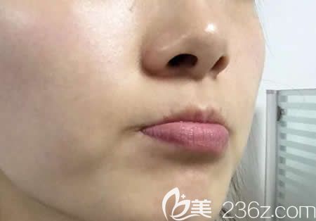 在<!--<i data=20240703-sp></i>-->整形醫(yī)院找周玲主任做激光祛斑術(shù)后第7天 在<!--<i data=20240703-sp></i>-->整形醫(yī)院找周玲主任做激光祛斑術(shù)后第7天