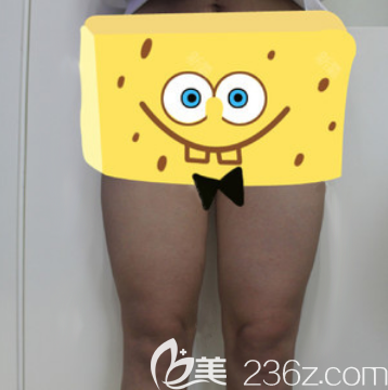 去成都西區(qū)醫(yī)院做大腿吸脂前照片 去成都西區(qū)醫(yī)院做大腿吸脂前照片