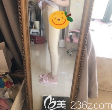 宋華敬大腿吸脂術后5天 宋華敬大腿吸脂術后5天