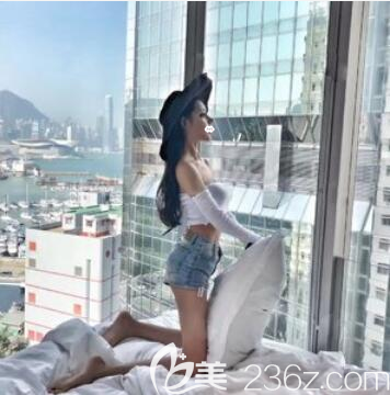 成都西區(qū)醫(yī)院大腿吸脂術后一個月恢復照片 成都西區(qū)醫(yī)院大腿吸脂術后一個月恢復照片