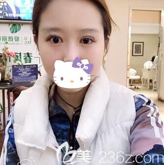 找劉志剛做雙眼皮修復(fù)術(shù)前照 找劉志剛做雙眼皮修復(fù)術(shù)前照