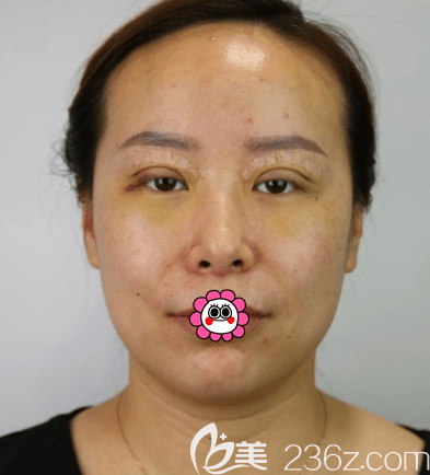 <!--<i data=20240703-sp></i>-->醫(yī)生給我做眼綜合第3天樣子