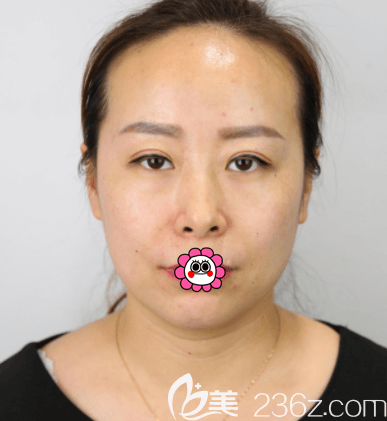 在北京惠合嘉美做眼綜合第26天樣子