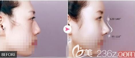 假體隆鼻(硅膠、膨體)