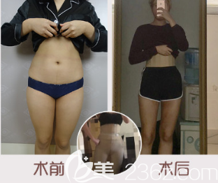 <i data-id='83af8841-c035-4b8e-8258-ec859ca8c7c0' style='display:none;'></i>婦嬰醫(yī)院-整形<!--<i data=20240703-sp></i>-->腿吸脂案例