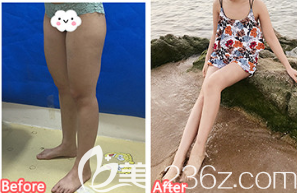 德州市友誼醫(yī)療美容診所大腿吸脂案例