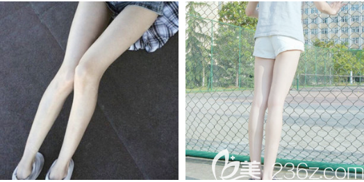 這次找佛山夢露整形游萬福院長做的大腿吸脂效果太好了,后悔沒有用抽出來的脂肪做隆胸