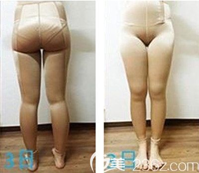 韓國純真安敬天腿部吸脂術(shù)后3天恢復(fù)效果