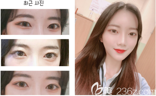 韓國純真醫(yī)院崔宰源雙重埋線+非切開提肌+開內(nèi)眼角后土氣變高級了