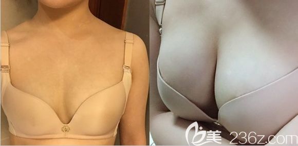 長(zhǎng)春姬安娣整形自體脂肪豐胸案例效果圖 長(zhǎng)春姬安娣整形自體脂肪豐胸案例效果圖