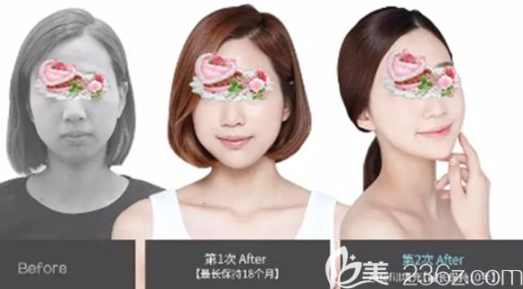 長(zhǎng)春姬安娣整形面部輪廓注射塑形案例效果圖 長(zhǎng)春姬安娣整形面部輪廓注射塑形案例效果圖